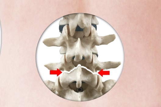 腰椎分離・すべり症
